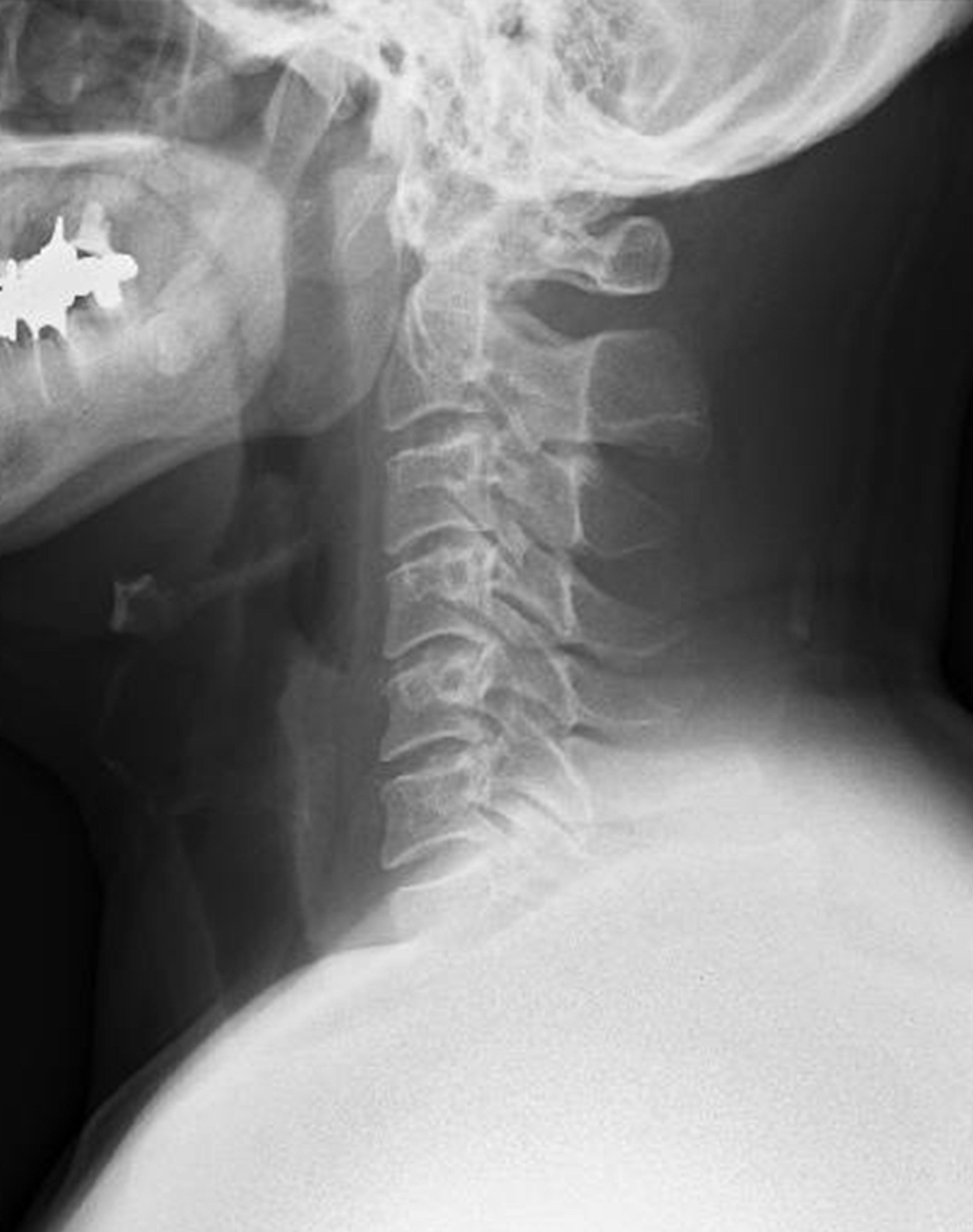 Imagen de rayos X del cuello que muestra las vértebras y la estructura espinal