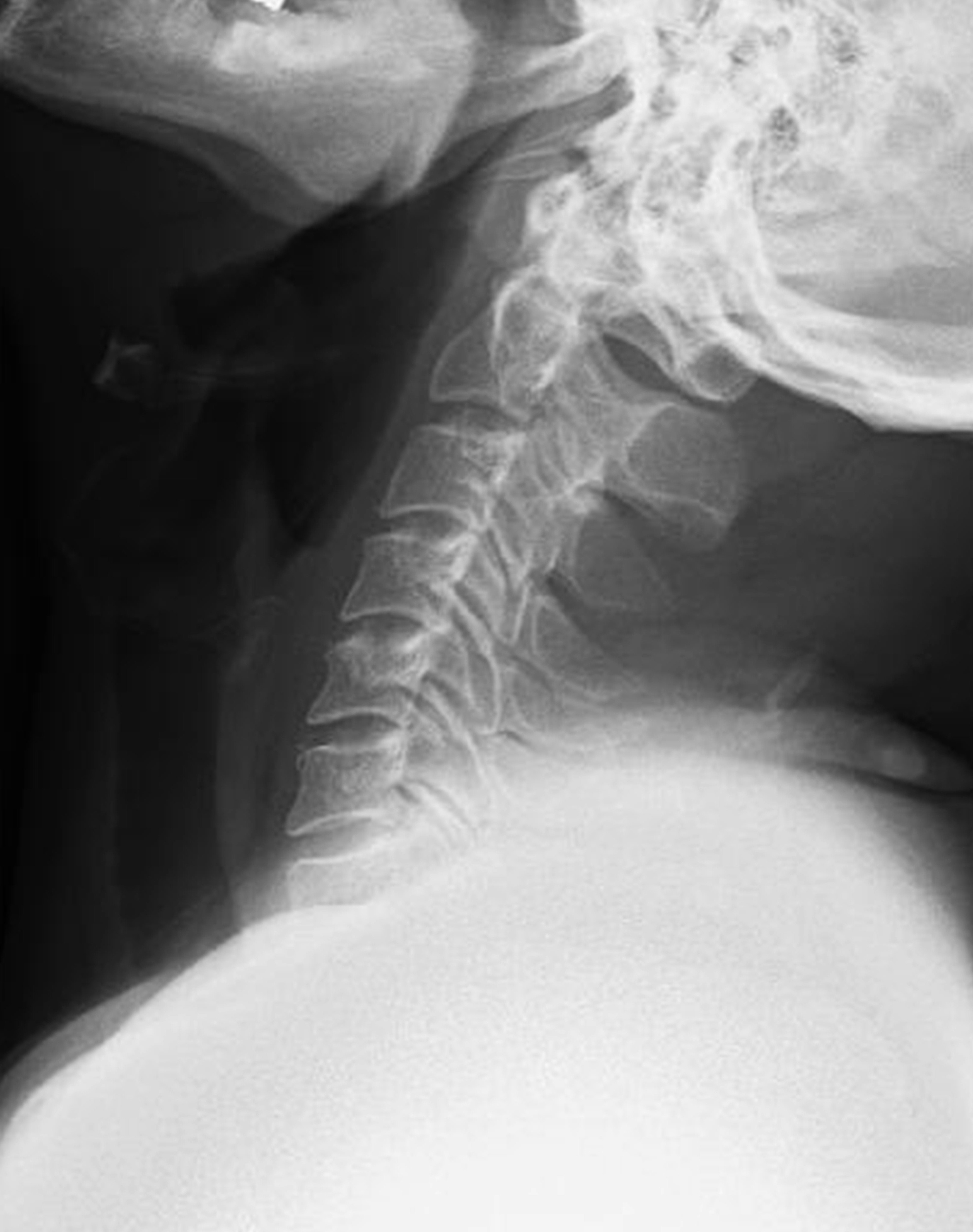 Gambar X-ray leher menunjukkan garis besar vertebra yang jelas