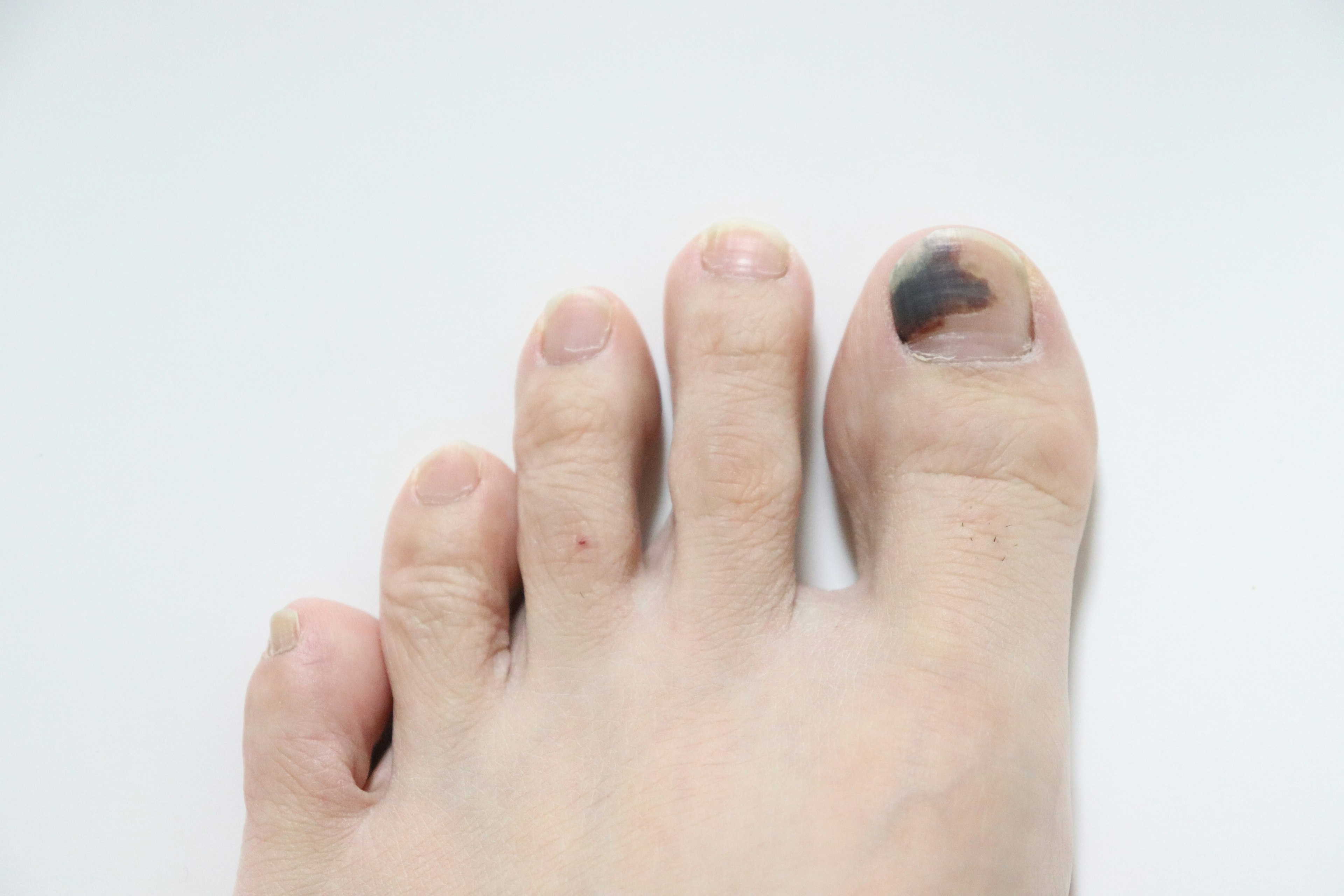 Foot with a bruised toenail and visible toes