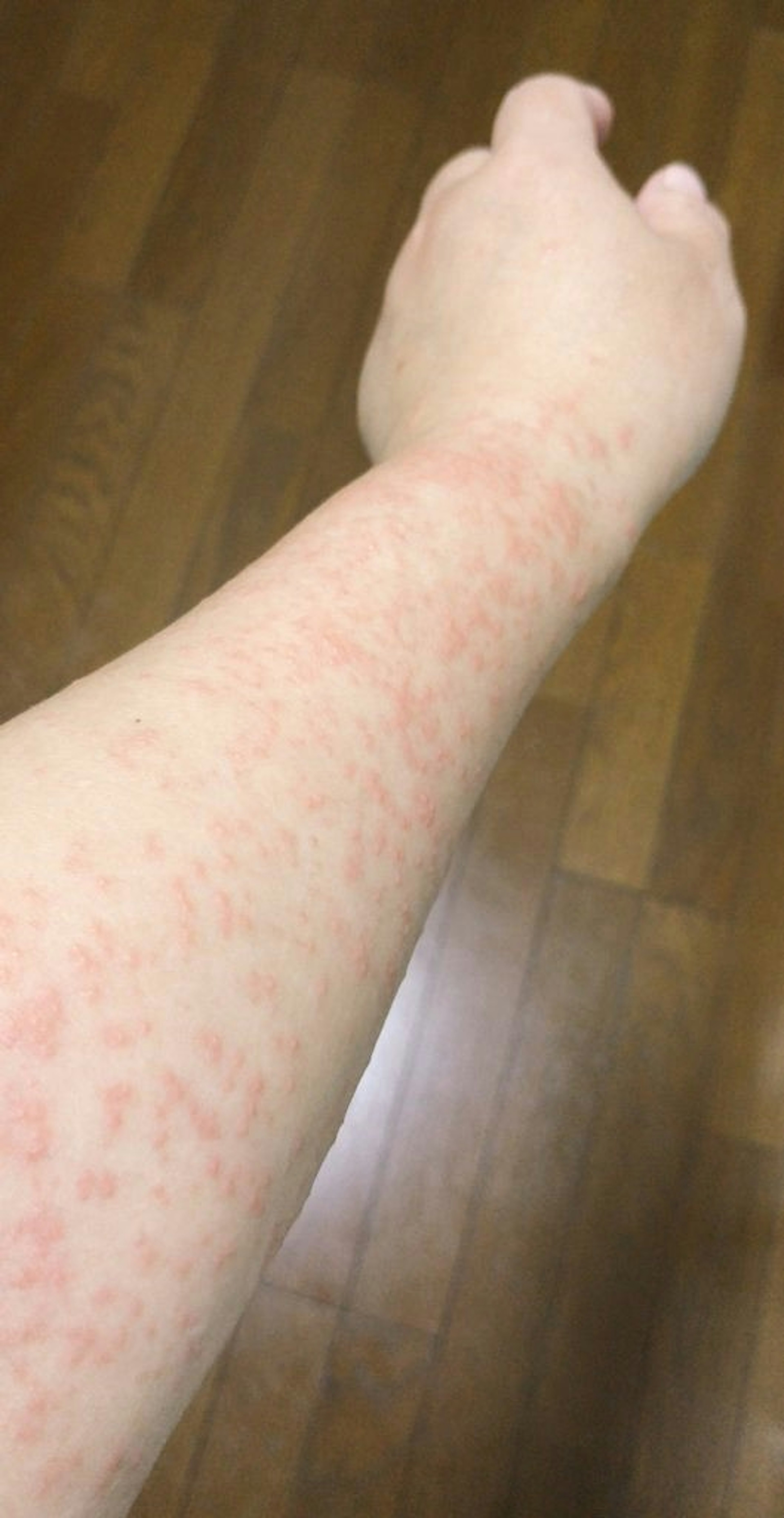 Photo of an arm with red spots