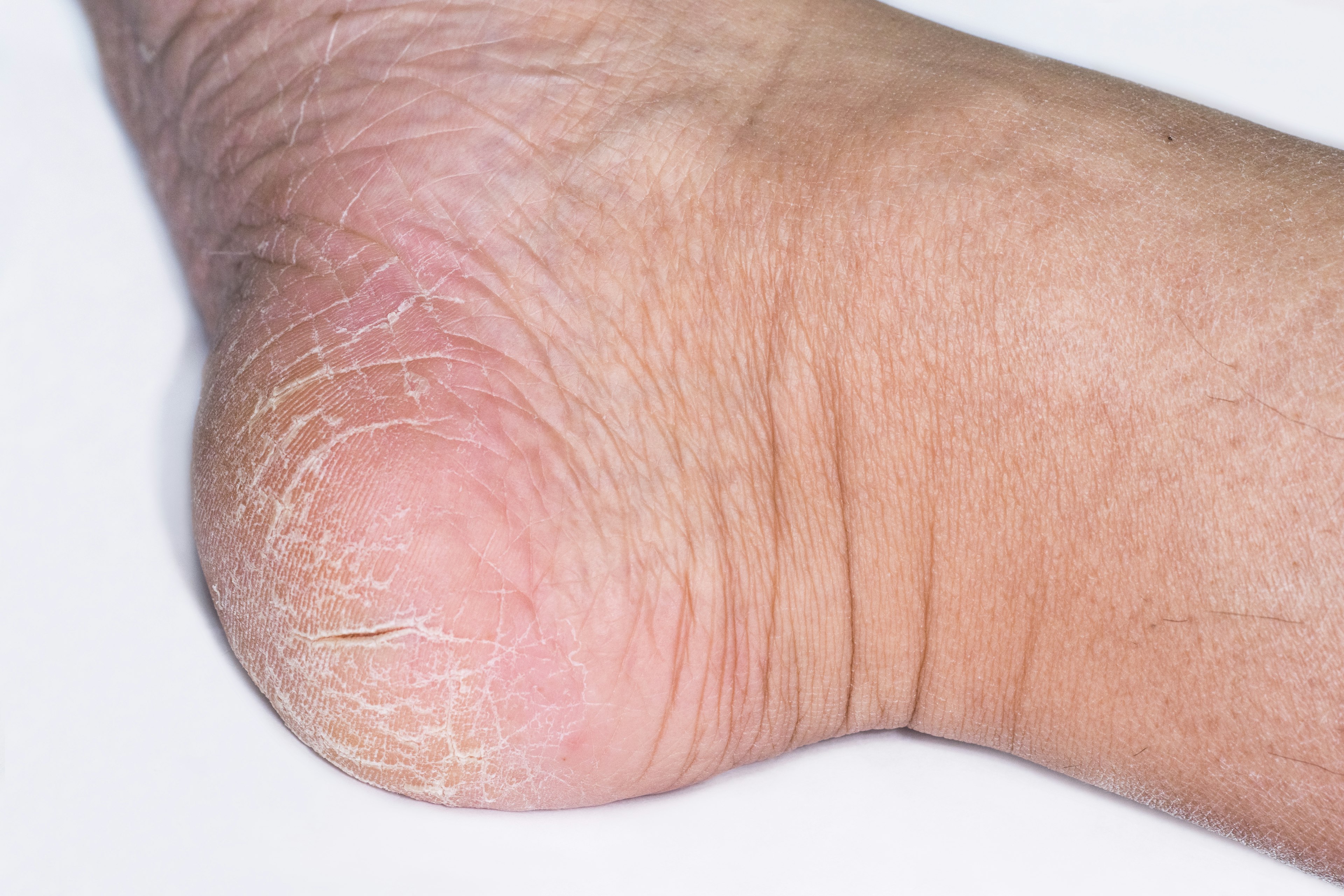 Close-up image of a dry heel on a foot