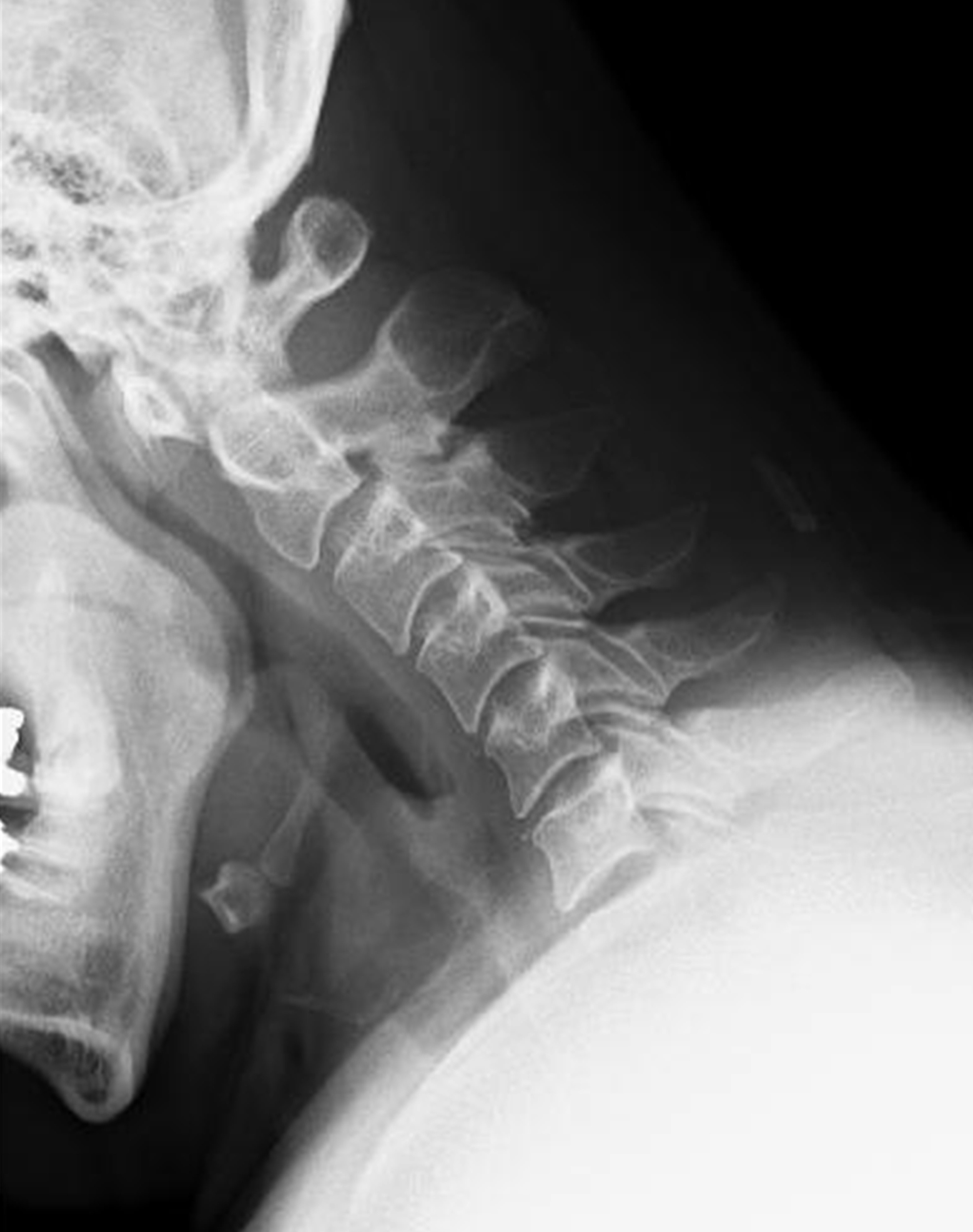 Immagine radiografica del collo che mostra chiaramente le vertebre cervicali