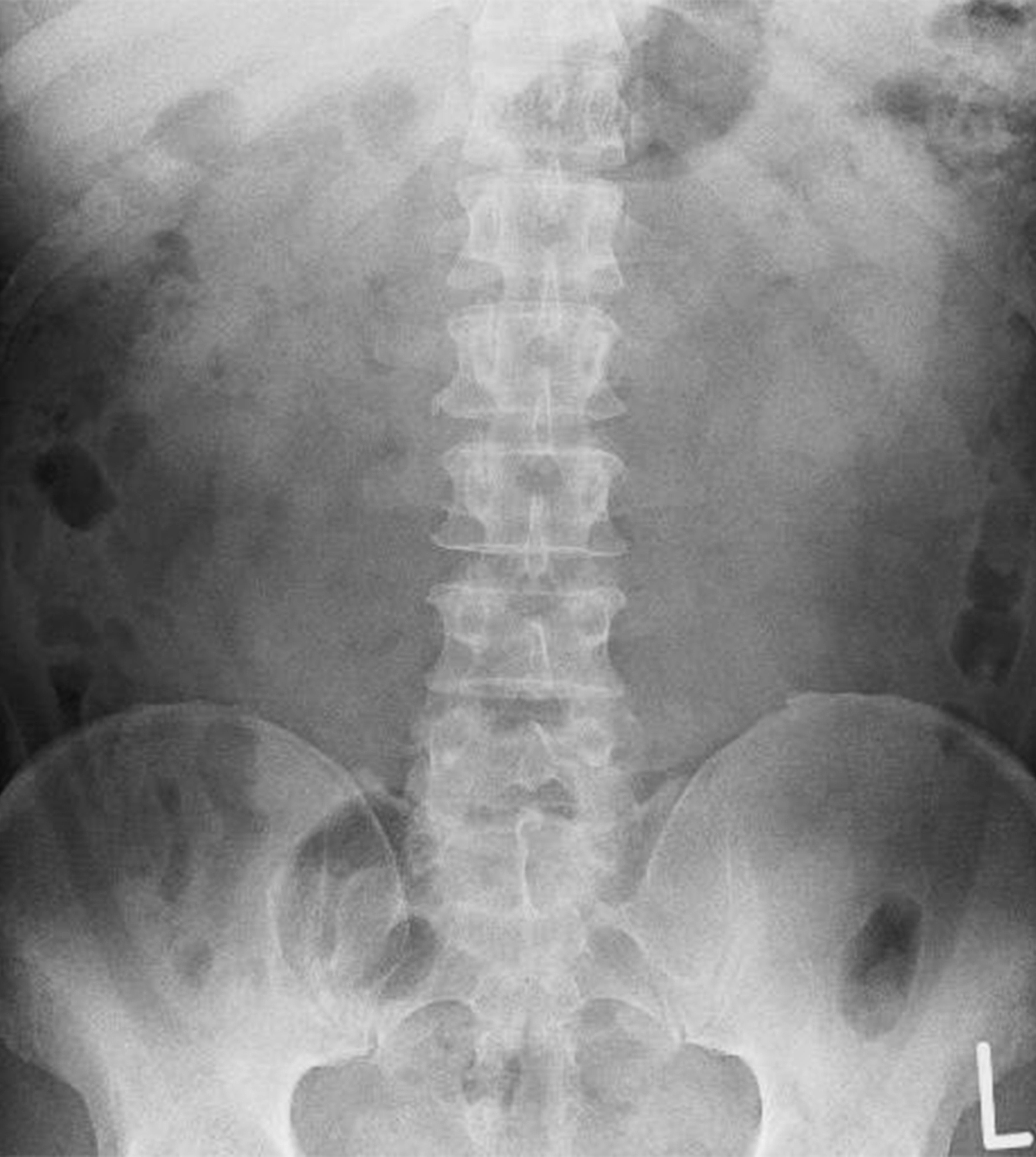 Image radiographique du bas du dos montrant des détails de la colonne vertébrale et du pelvis