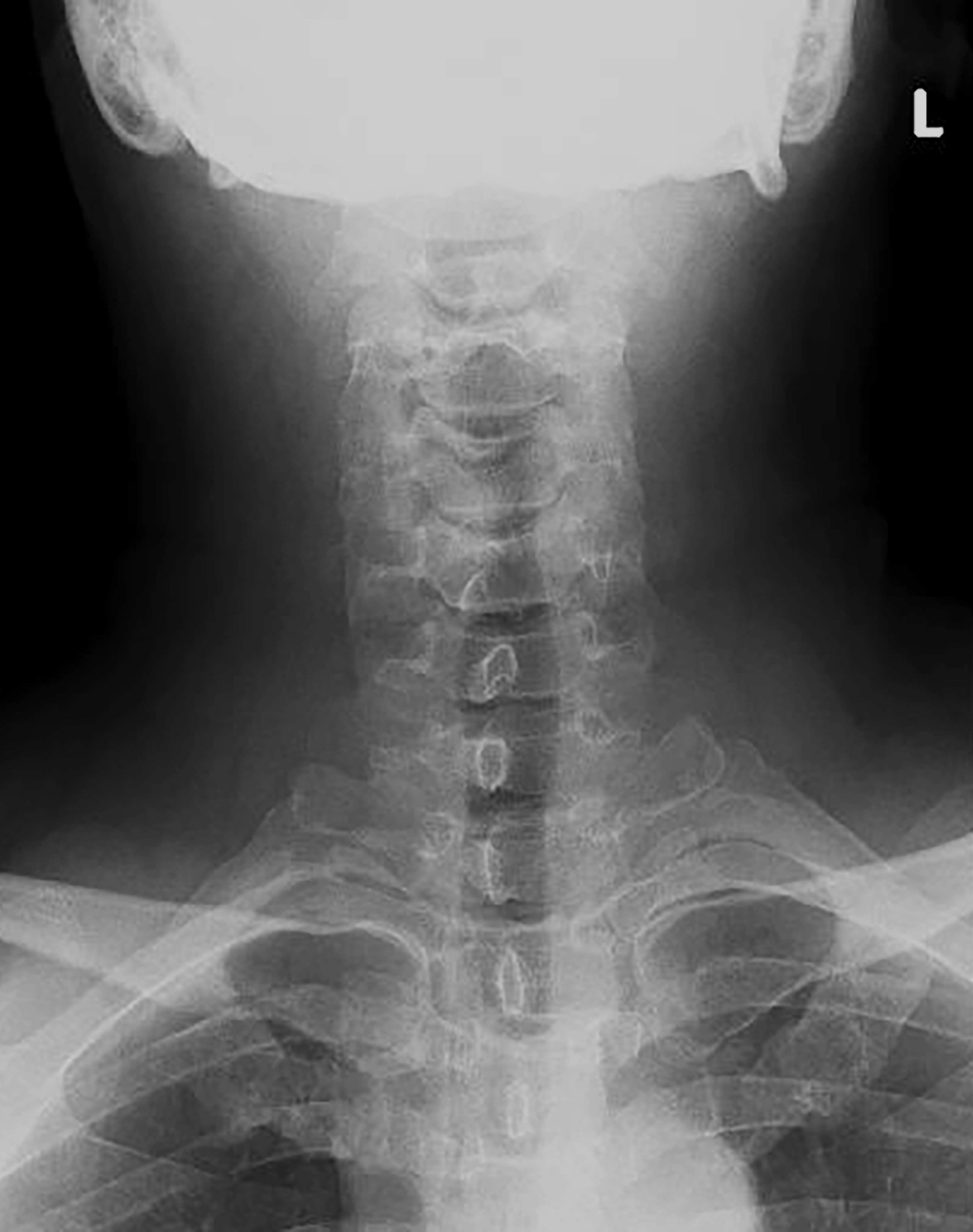 Image radiographique du cou montrant des vertèbres cervicales claires